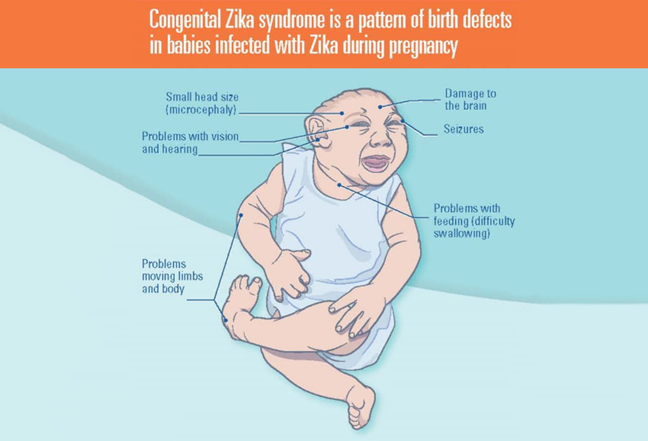 ocular-findings-in-infants-with-congenital-zika-virus-infection