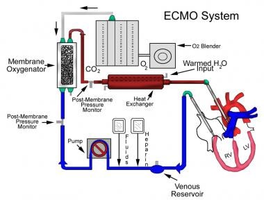 vv ecmo circuit