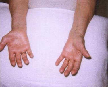 The hands of an 80-year-old woman with a several-y