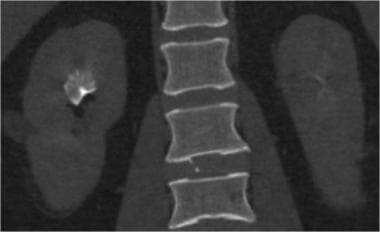 Medullary sponge kidney: CT urogram in the excreto