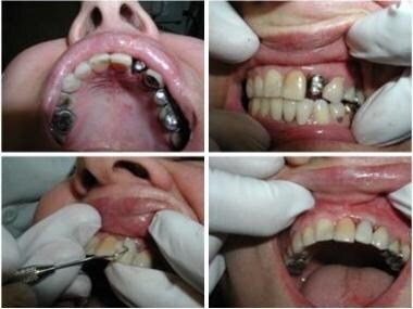 Dental implants: Mandibular neurovascular considerations 