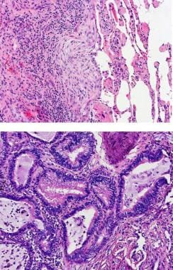 Top image: Fibroblastic focus (x200). Bottom image