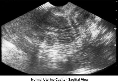 Infertility. Sonogram: Sagittal view of normal ute