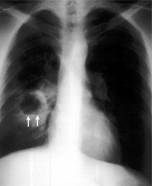 Brain abscess. Anterior view of a chest radiograph