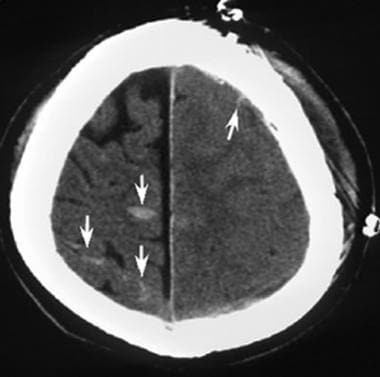 Acute gliding brain contusions. Axial CT scan obta