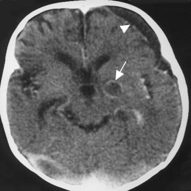 Cerebritis and developing abscess formation in a p