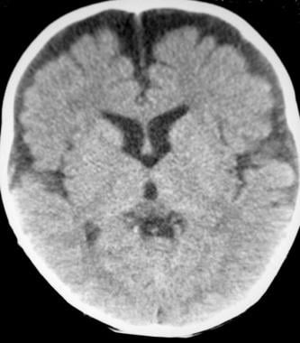 Axial computed tomography scan shows benign enlarg