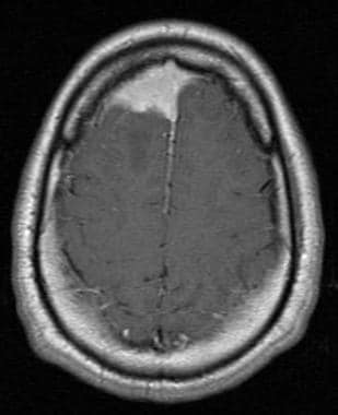 Axial MRI of the cerebrum: Contrast-enhanced axial