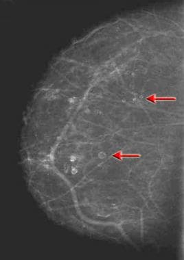 Craniocaudal mammogram demonstrating multiple oil 
