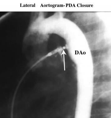 Lateral aortogram. This image was obtained during 