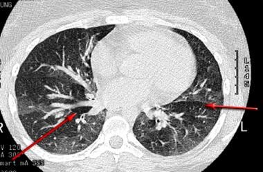 High-resolution CT scan of the thorax obtained dur