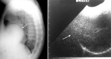On the left, a right lateral chest radiograph show