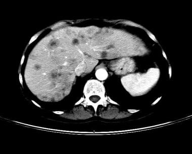 Lung cancer, small cell. Contrast-enhanced CT scan