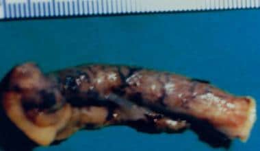Distended gangrenous appendix; pathologic specimen