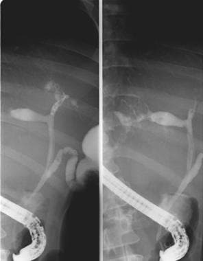 Caroli disease. Endoscopic retrograde cholangiopan