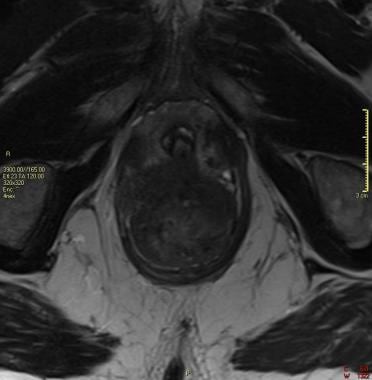 T2-weighted axial image of a 71-year-old patient w