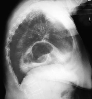 A lateral chest radiograph showing a hiatal hernia
