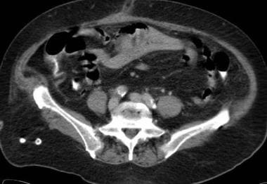 Mesenteric ischemia. CT scan in a 76-year-old woma