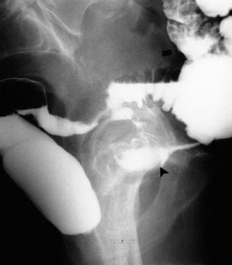 Contrast-enhanced study of the lower bowel shows a