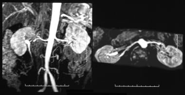 Renal artery stenosis/renovascular hypertension. D