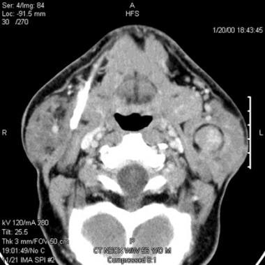 Parotid, malignant tumors. Image shows a well-circ