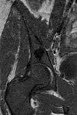 Magnetic resonance imaging (MRI) scan of the hip. 
