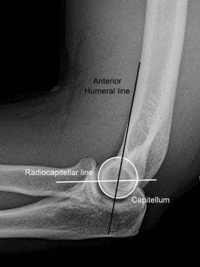 Normal elbow. Anterior humeral line and radiocapit