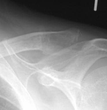 Radiograph of the shoulder in a patient with prima
