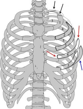Image représentant des fractures multiples de la paroi thoracique supérieure gauche