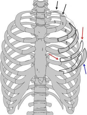 Triangle of safety as outlined by the superior aspect of the fifth rib