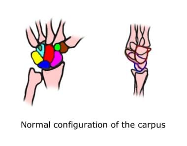 Wrist, perilunate injuries. Line diagram depicts n