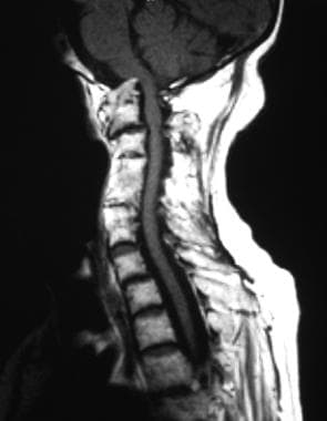 T1-weighted sagittal MRI of the cervical spine sho