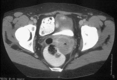 CT of clinical stage IIB cervical carcinoma. This 