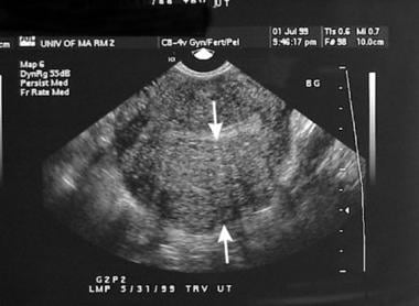 Transvaginal sonogram of an enlarged uterus with a
