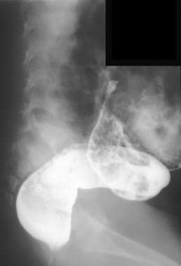 Hirschsprung disease. Barium enema showing reduced