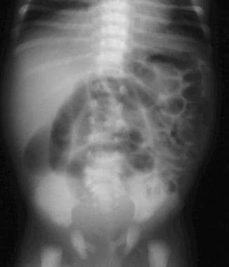 Supine frontal view of the abdomen in a newborn wi
