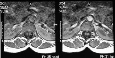 Axial MRIs in the same patient as in the previous 