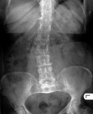 The spine is often affected in achondroplasia. Fea