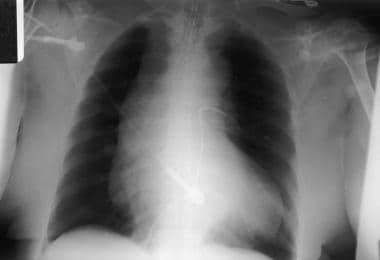 Plain anteroposterior view of the chest demonstrat