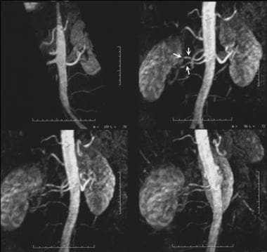 What Is The Role Of Magnetic Resonance Angiography Mra In - 