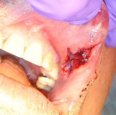 Deep intraoral lip laceration that needs repair. 