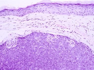 Histologic appearance of nodular Merkel cell carci