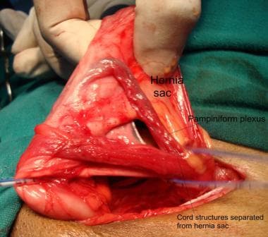 Open inguinal hernia repair. Indirect hernia sac s
