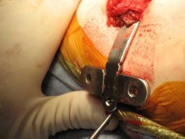Nuss procedure. Pectus bar being pulled out of che