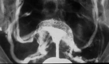 Dramatic extravasation of contrast media is seen i