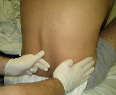 Lumbar on sale puncture pictures