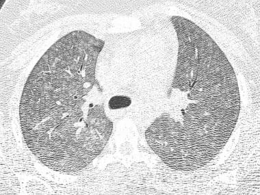 Chest CT from same patient as previous image revea