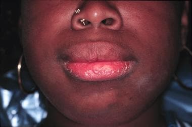 Lower facial appearance of a 14-year-old adolescen
