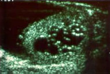 Ultrasonogram revealing cystic dysplasia of testic