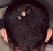 Scarring Alopecia